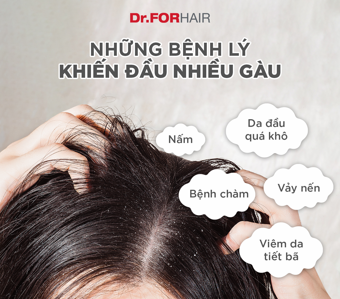 Những bệnh lý có thể gây ra gàu