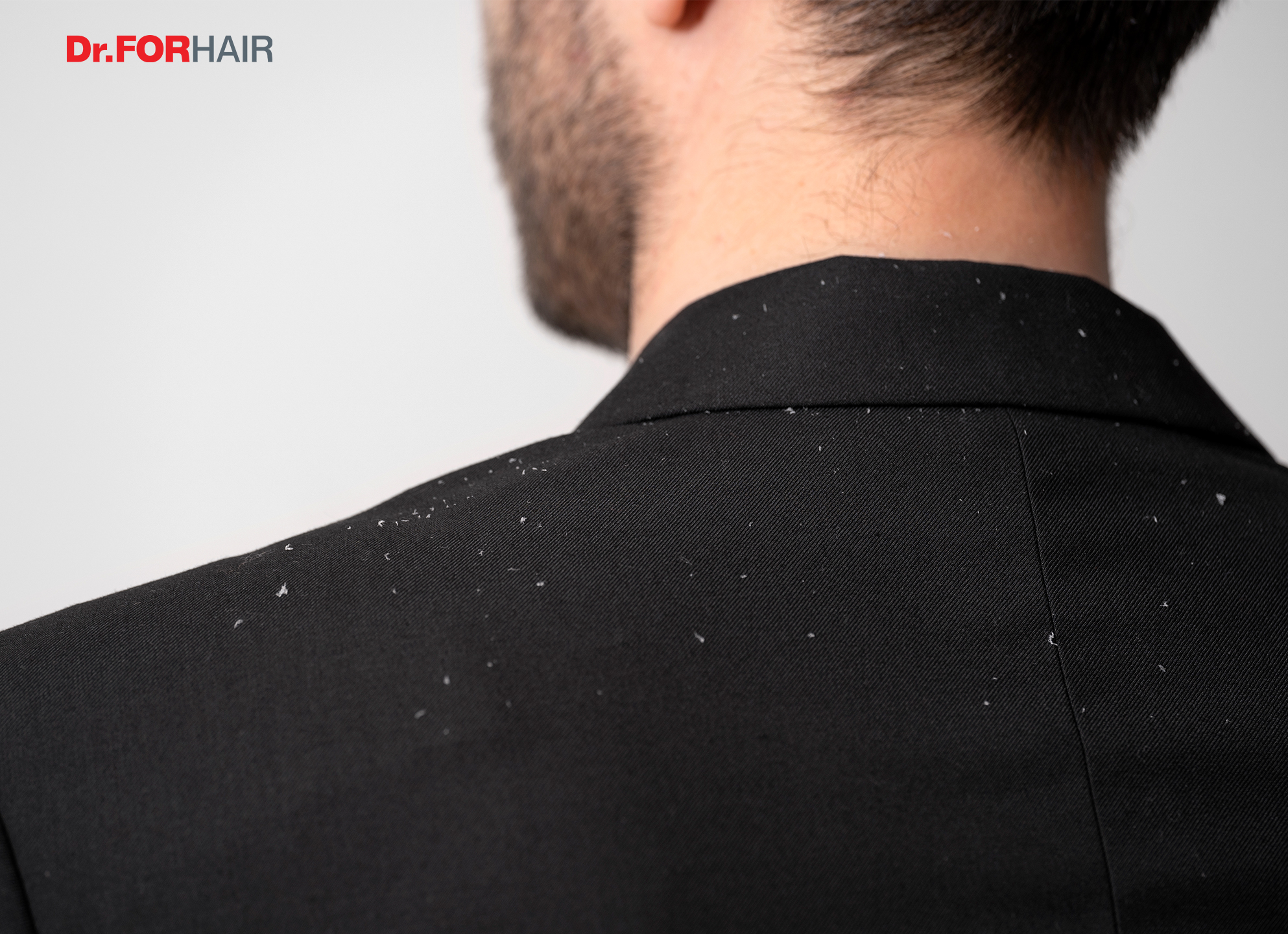 Gàu là một trong những nguyên nhân khiến mọi người tự ti đi nhiều