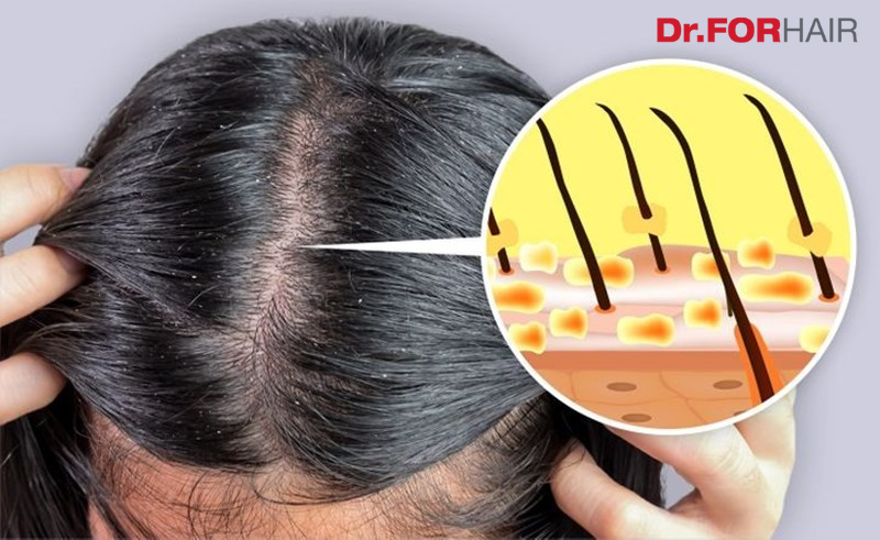 Vảy gàu là những tế bào chết trên da đầu, bị khô và bong tróc thành từng mảng