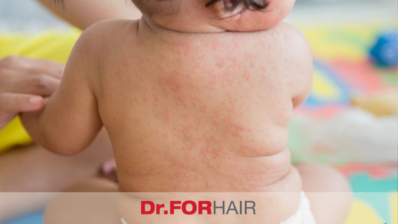 Trẻ bị rôm sảy