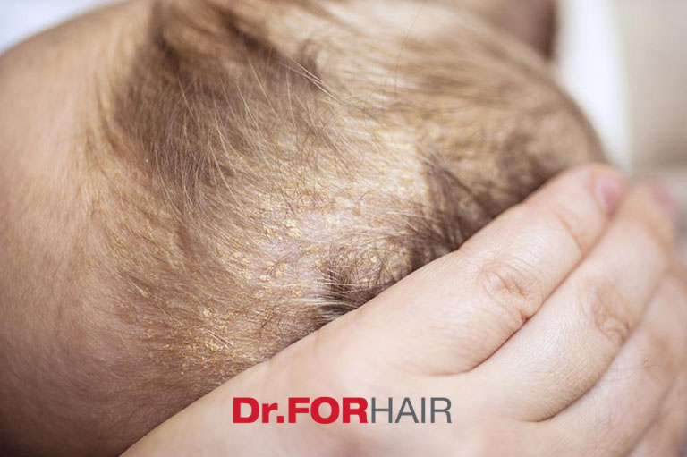 Trẻ bị viêm da tiết bã
