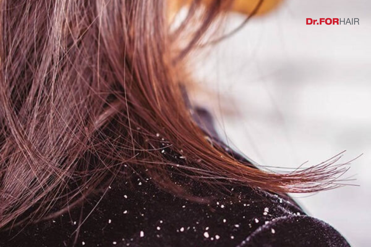 dầu gội trị rụng tóc