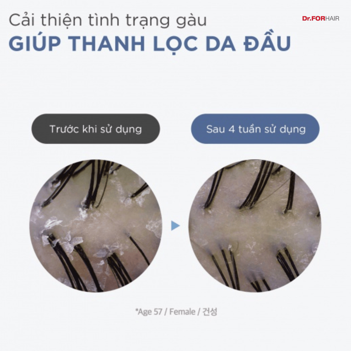 gàu da đầu