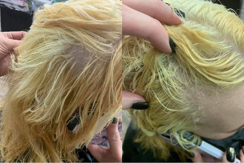 Tẩy nhuộm quá nhiều gây rụng tóc, hói đầu