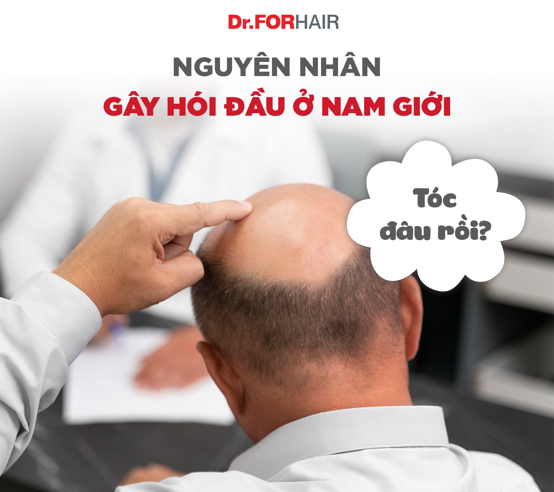 hói đầu ở nam giới