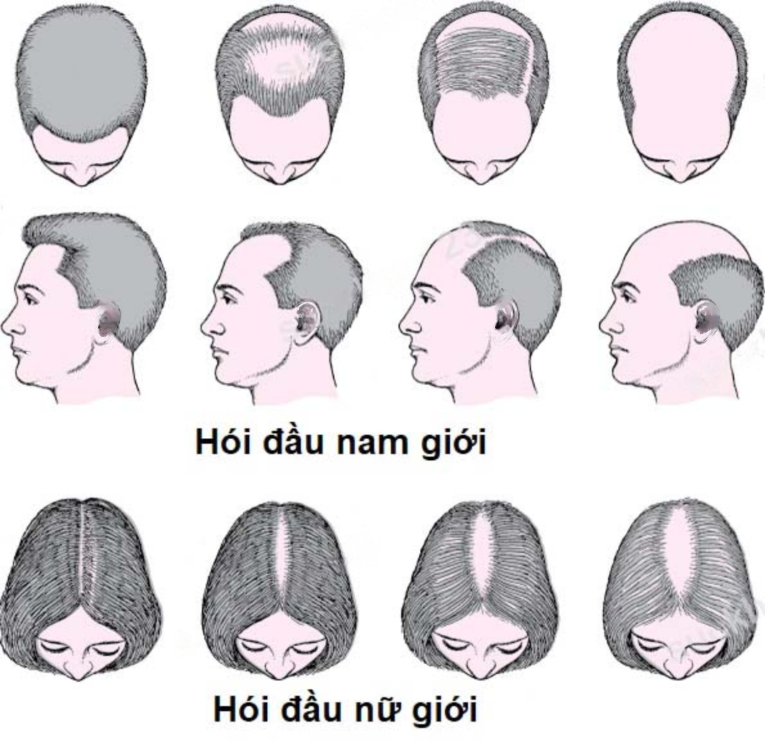 Hói đầu có thể xảy ra ở cả nam và nữ
