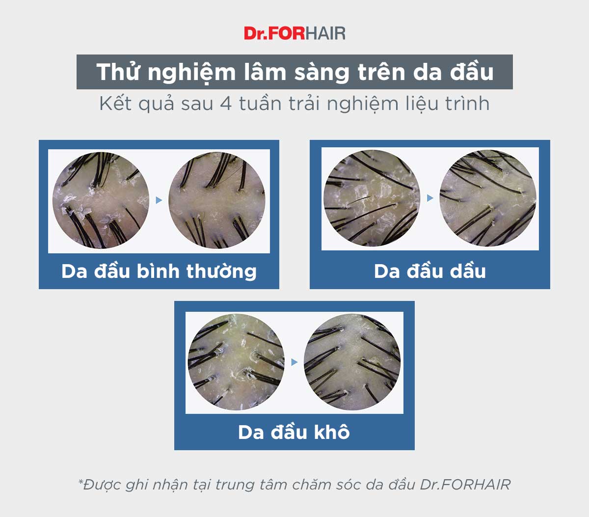 liệu trình trị gàu