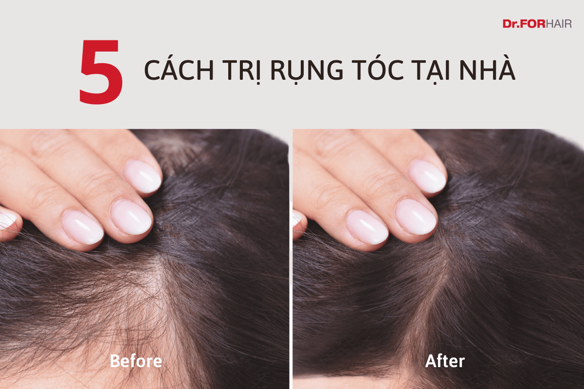 trị rụng tóc